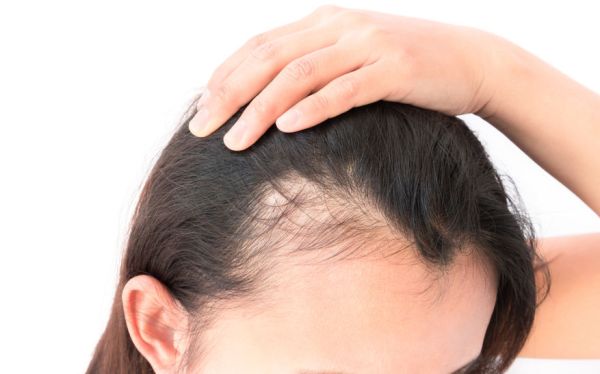 menopausal hair loss in women