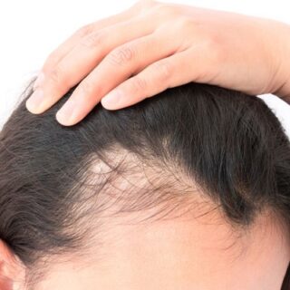 Menopausal Hair Loss